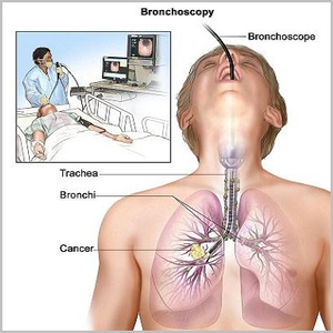 肺癌诊断